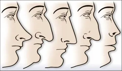 حداقل سن عمل زیبایی بینی/دو عارضه حاد جراحی غیر استاندارد