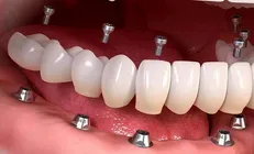 تولید ایمپلنت دندان در مرکز رشد دانشگاه صنعتی ارومیه