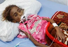 وزیر بهداشت یمن: سازمان ملل ۲ بار کودکان یمنی را به قتل رساند