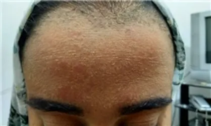جدال زهرای ۱۷ ساله با بیماری نادر/ بیمه زیر بار هزینه&zwnj;های درمان نرفت +شماره حساب برای کمک
