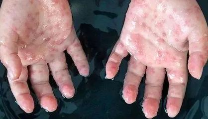 شناسایی موارد جدید ابتلا به آبله میمونی در امارات