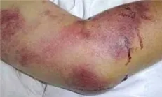 اعزام متخصصان ایرانی برای پیشگیری از تب کریمه به افغانستان