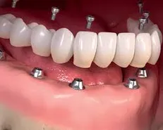 شرط انجام ایمپلنت در بیماران دیابتی/ایمپلنت درمان لاکچری نیست