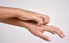 خارش پوست، جدیدترین نشانه ابتلا به ویروس کرونا