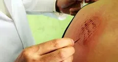 روایتی از پیامبر اکرم (ص) درباره حجامت/ چه افرادی نبایستی عمل حجامت را انجام دهند؟
