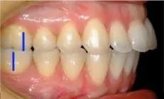 آمار قابل توجه ناهنجاری‌های فک و صورت در کشور/ نتایج جراحی‌های ارتوگناتیک