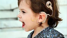 تقبل ۸۸ درصدی هزینه‌های کاشت حلزون شنوایی