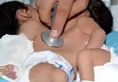 عمل جداسازی دوقلو‌های به‌هم‌چسبیده در شیراز با موفقیت انجام شد