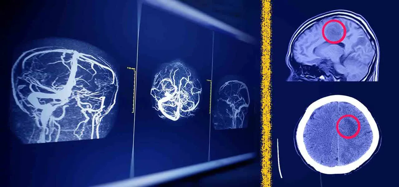 راه‌ حل جدید پژوهشگران دانشگاه تهران برای افزایش امنیت هوش مصنوعی در تحلیل MRI مغز