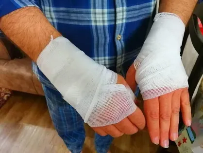 میزان هزینه کرد بیمه سلامت در درمان افراد دچار سوختگی