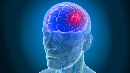 صدای بلند سکته مغزی در جامعه را بشنوید/  افزایش مرگ و میر سکته مغزی در زمان کرونا