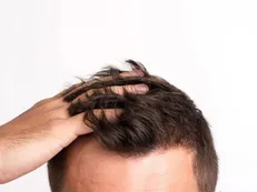 پس از کاشت مو چه مواردی را باید رعایت کنیم؟
