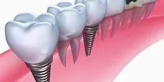 دلیل ایجاد عوارض در ایمپلنت/ ارائه جدیدترین دستاورد‌های علمی در حوزه ایمپلنت، زیبایی و بازسازی استخوان
