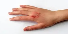 پیشگیری از سوختگی هزینه بالای اقتصادی را تحمیل می کند
