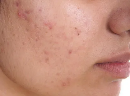 خوراکی&zwnj;های موثر در بروز آکنه