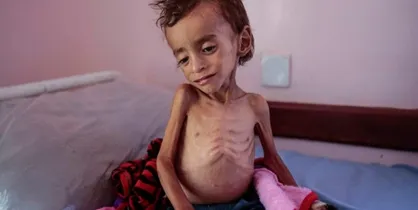 سازمان&zwnj;ملل: ۴۰۰ هزار کودک یمنی در خطر مرگ به دلیل سوء تغذیه هستند