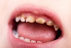 تأثیر مخرب فست‌فود و نوشابه‌های گازدار برای دندان/ راه‌هایی که از پوسیدگی دندان پیشگیری می‌کند