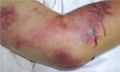 اعزام متخصصان ایرانی برای پیشگیری از تب کریمه به افغانستان