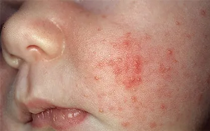 افزایش سرخک در کشور طی سال جاری/ بررسی ۱۲۰۰۰ نمونه در سال