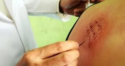 روایتی از پیامبر اکرم (ص) درباره حجامت/ چه افرادی نبایستی عمل حجامت را انجام دهند؟