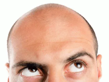 توصیه&zwnj;های طب سنتی برای جلوگیری از کچل شدن