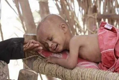افزایش شمار کودکان یمنی مبتلا به سرطان در نتیجه جنگ و محاصره
