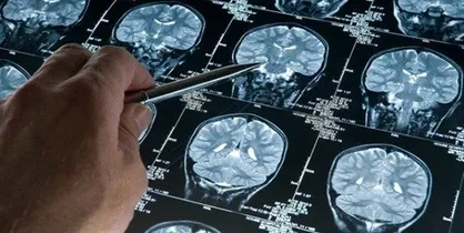 مهم&zwnj;ترین عوامل بروز سکته مغزی/ سکته مغزی نیاز به مراقبت حاد دارد
