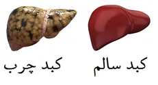 برترین درمان کبد چرب بدون دارو و گیاه