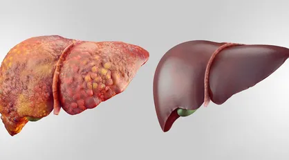 دم دستی&zwnj;ترین راه&zwnj;&lrm;ها برای مقابله با کبد چرب/ ۱۲ روش طب سنتی برای درمان کبد چرب