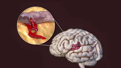 پاکسازی خون&zwnj;ریزی در مغز با یک ابزار قابل کنترل
