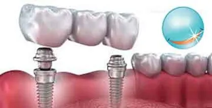 ایمپلنت چیست و در این درمان به چه نکاتی باید توجه کرد