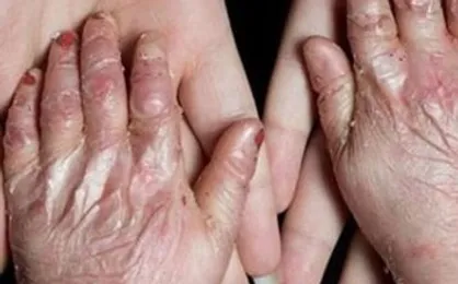 بیش از ۹۰ درصد مبتلایان به&zwnj; &laquo;ای بی&raquo; حاصل ازدواج&zwnj; فامیلی هستند