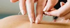 تاثیر طب سوزنی بر درمان ناباروری