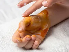 توصیه‌ها اورژانسی در سوختگی‌ها