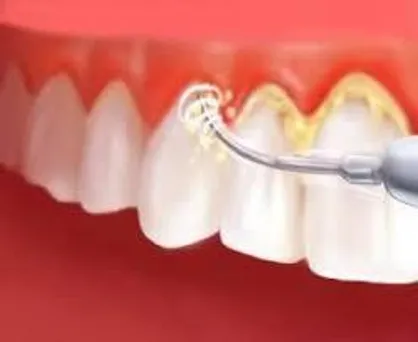 جرم&zwnj;گیری هیچ تاثیر منفی بر مینا و ریشه دندان&zwnj;ها ندارد