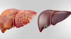دم دستی‌ترین راه‌‎ها برای مقابله با کبد چرب/ ۱۲ روش طب سنتی برای درمان کبد چرب