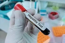 ۱۹ هزار تست و ۶۷۵ بیمار تحت درمان/گام‌های مؤثر در مقابله با هپاتیت C