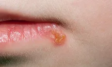 نسخه تجویز شده طب سنتی برای درمان آفت و تبخال