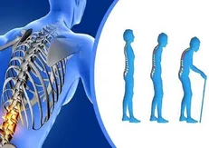 افزایش ۳۰ درصدی اختلالات اسکلتی و عضلانی دانش‌آموزان