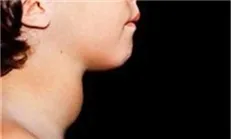 عوارضی که کم‌کاری تیروئید مادرزادی به همراه دارد