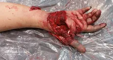 پیوند انگشتان قطع شده جوان ۱۷ ساله در یزد