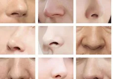 حداقل و حداکثر سن برای انجام جراحی بینی/ شایع‌ترین عوارض رینوپلاستی را بشناسید