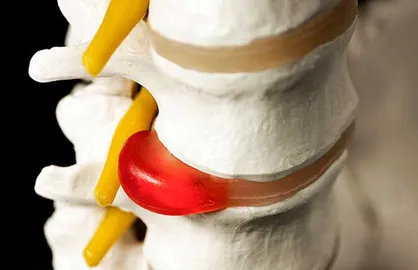 نسخه طب سنتی برای تسکین درد&zwnj;های مفصلی و سیاتیک