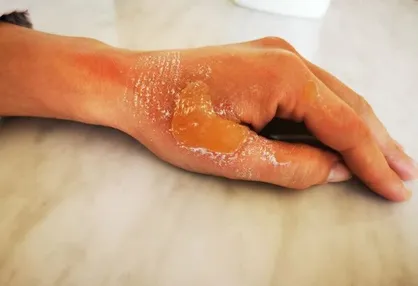 بیمه سلامت چقدر از هزینه&zwnj;های درمان سوختگی را پوشش می&zwnj;دهد؟