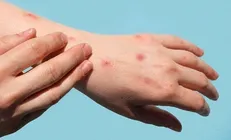 راه اندازی آزمایش بزرگ درمان آبله میمونی در آفریقا