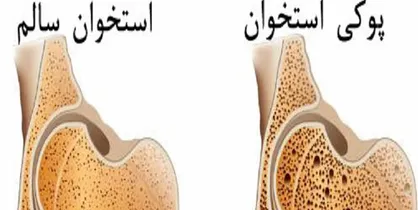 ۲ راهکار اصلی پیشگیری از پوکی استخوان
