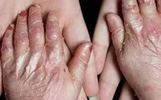 بیش از ۹۰ درصد مبتلایان به‌ «ای بی» حاصل ازدواج‌ فامیلی هستند