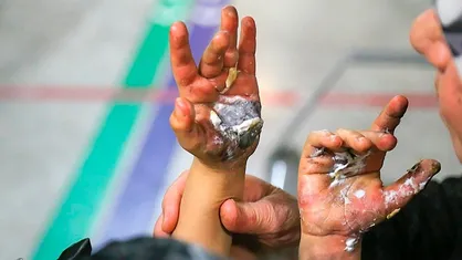 افزایش مصدومان چهارشنبه&zwnj;سوری در البرز / سه مورد قطع انگشت گزارش شد