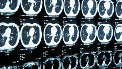 MRI نانویی می&zwnj;تواند سرطان را زودهنگام شناسایی کند