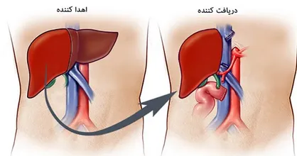 ماجرای فروش کبد ۵۰۰ میلیونی در پایتخت/ شرایط پیوند کبد زنده به زنده